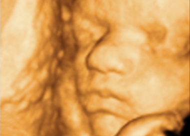 gravid ultralyd tidlig fosterdiagnostikk svangerskap