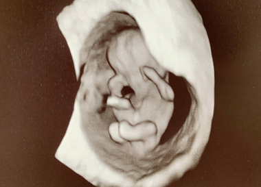 3D ultralyd, 3D/4D ultralyd, fosterdiagnostikk, tidlig ultralyd, ultralyd gravid